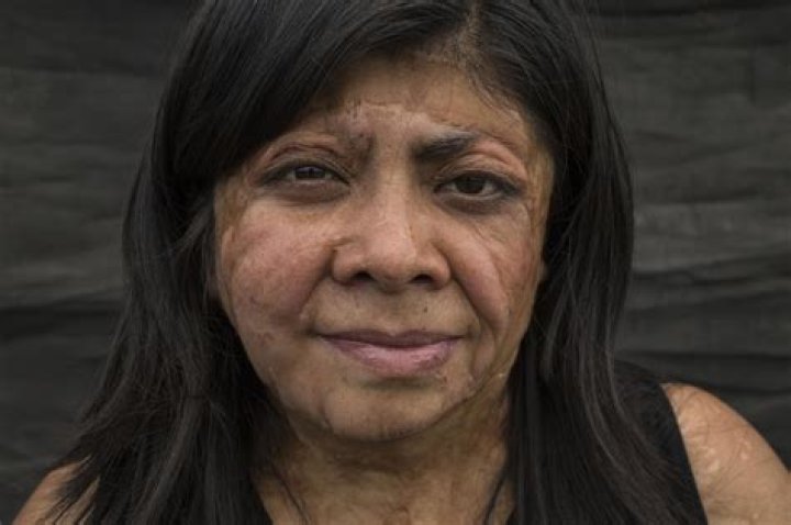 Warning: Graphic Content - Acid Attacks: The Devastating Impact On Faces