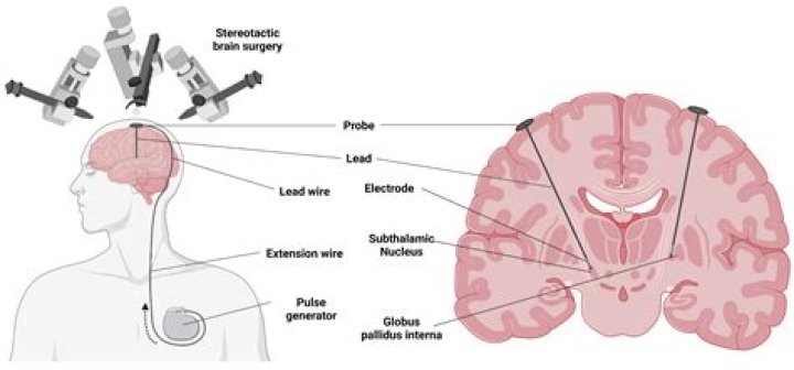 AEW Personnel Recently Underwent Brain Surgery to Battle Parkinson’s Disease