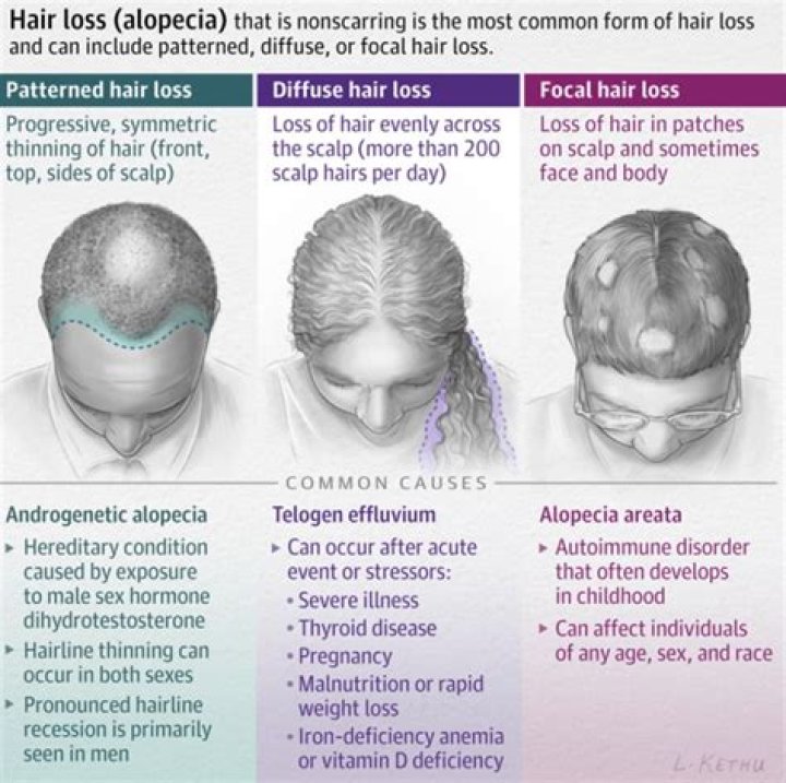 What is alopecia? – The US Sun