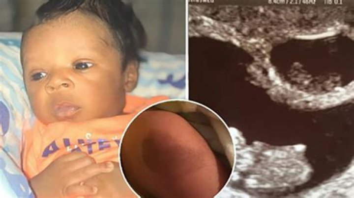 Baby ‘vanishes’ from ultrasound and her twin is born with a special mark