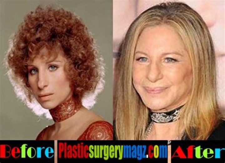 Barbra Streisand: The Journey Through Surgery And Self-Acceptance