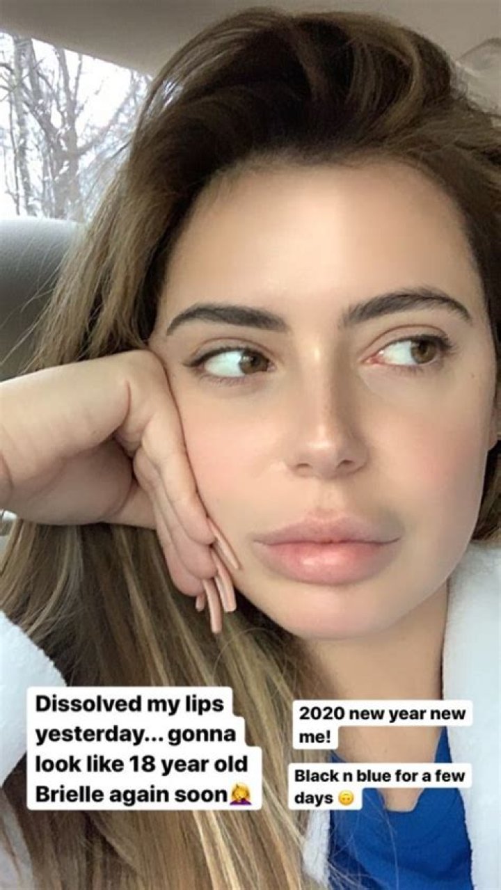 Brielle Biermann Says She Is Getting Her Lip Fillers Dissolved: Pic
