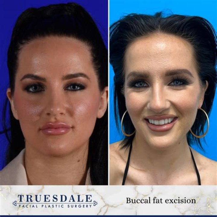 Celebrities who have had buccal fat removal: Before and after photos