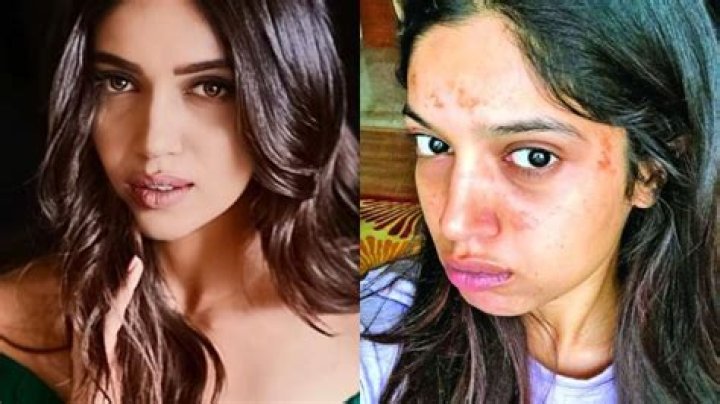 Bhumi Pednekar gets burn marks on face during Saand Ki Aankh shoot, proudly calls them battle scars – India TV