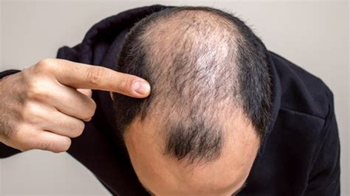 Miracle cure for baldness may lie in old, cheap hair-loss pill as medics tout 'cost-effective' treatment
