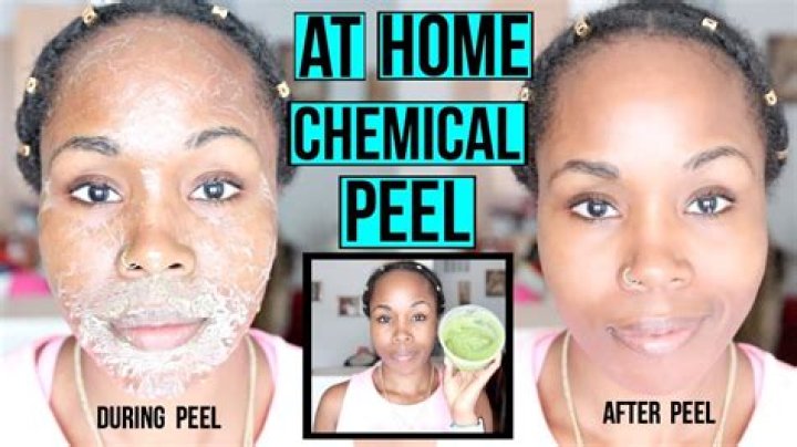 Chemical Peels Explained: Treatments, Benefits & Aftercare