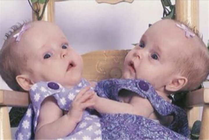 Cojoined twin sisters who were famously ‘cut In half’ in 2006 are now living as separate teenagers