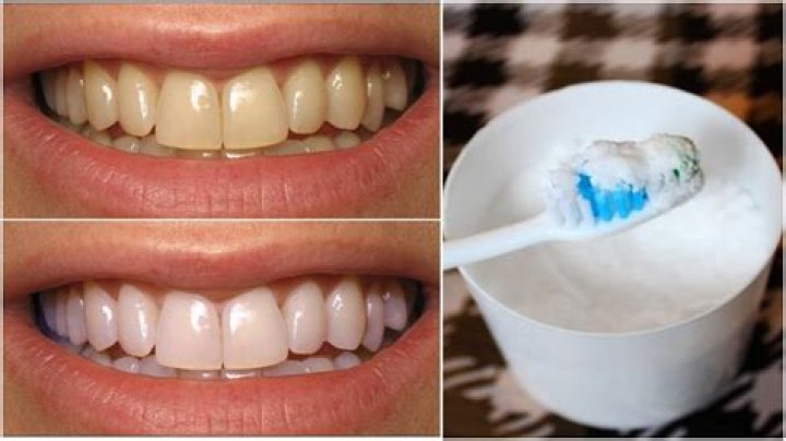 Question: Does Milk Whiten Your Teeth