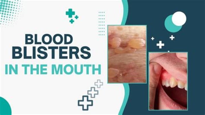 Warning over little-known condition 'triggered by eating fried food' that causes blood-filled blisters in your mouth