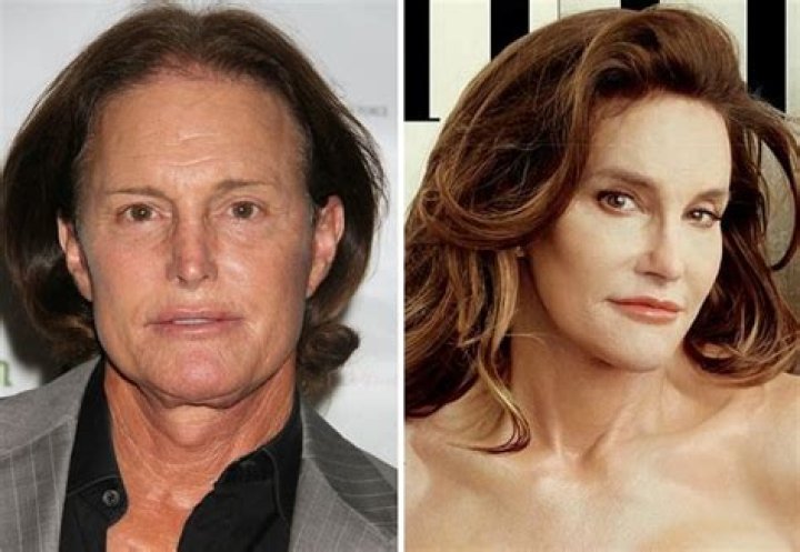 Unveiling The Truth: Has Bruce Jenner Had Reassignment Surgery?