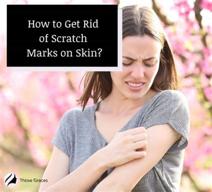 How To Get Rid Of Scratch Marks On Skin