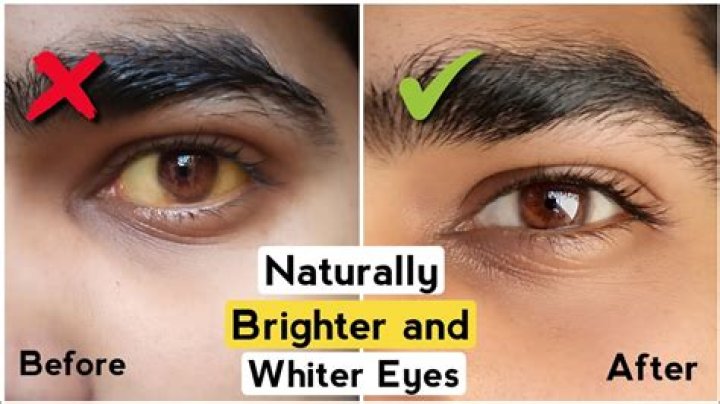 Question: How To Remove Yellowness From Eyes