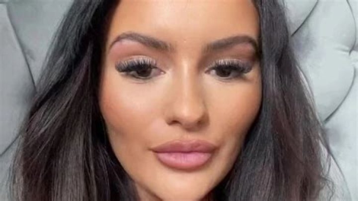 I totally changed my face with chin filler, not everyone agrees I look better but you can’t put a price on confidence