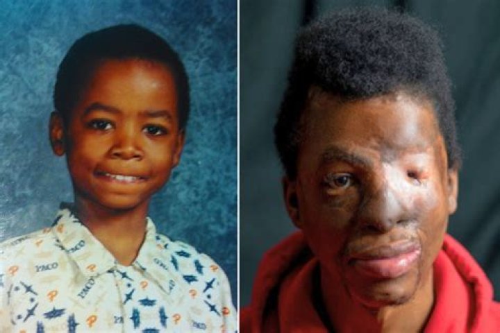 I Was Mauled by Pit Bulls as a Child