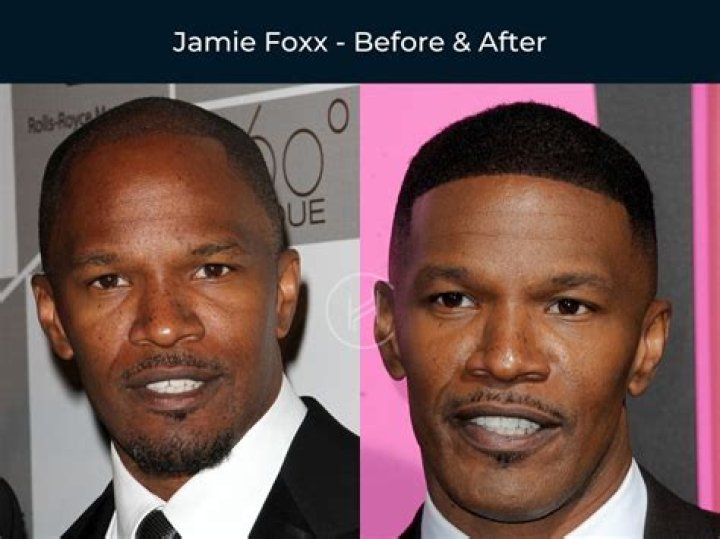 Jamie Foxx's Dramatic Transformation Before And After Hospitalization