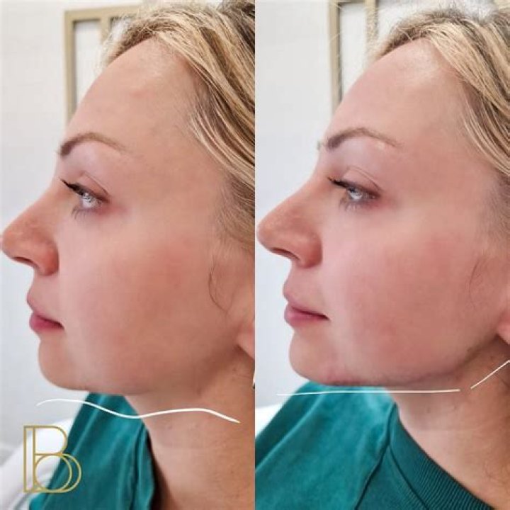 Jaw Filler: Everything to Know Before You Make an Appointment Including Side Effects, Pricing