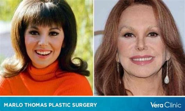 Marlo Thomas Facelift What Happened To Marlo Thomas Face? Has Marlo Thomas Had Plastic Surgery? | Who Are Marlo Thomas Parents?