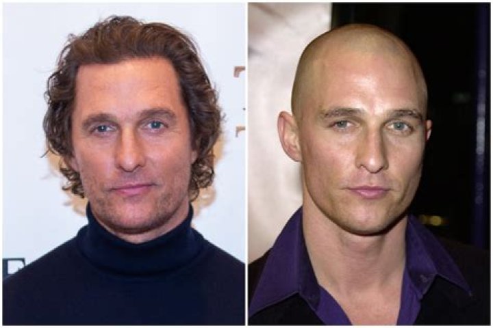 Matthew McConaughey Clears Up Hair Transplant Rumor After Battling Baldness