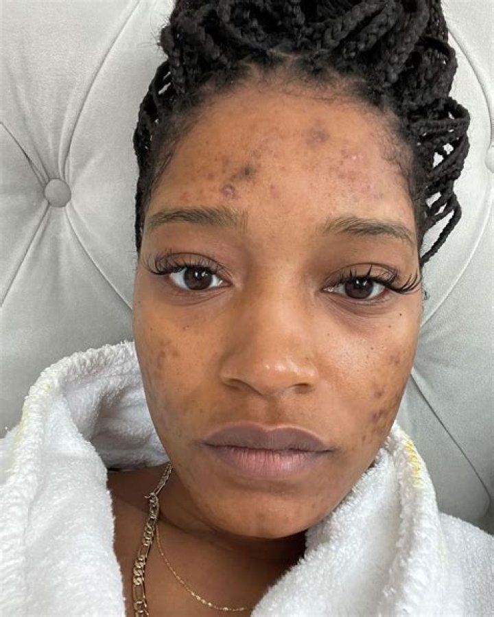 Mindy Kaling and More Stars Who Normalize Adult Acne on Social Media