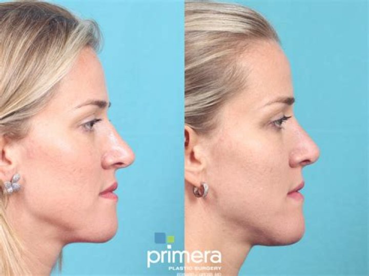 Model warns of plastic surgery as she came within hours of losing her nose after botched filler
