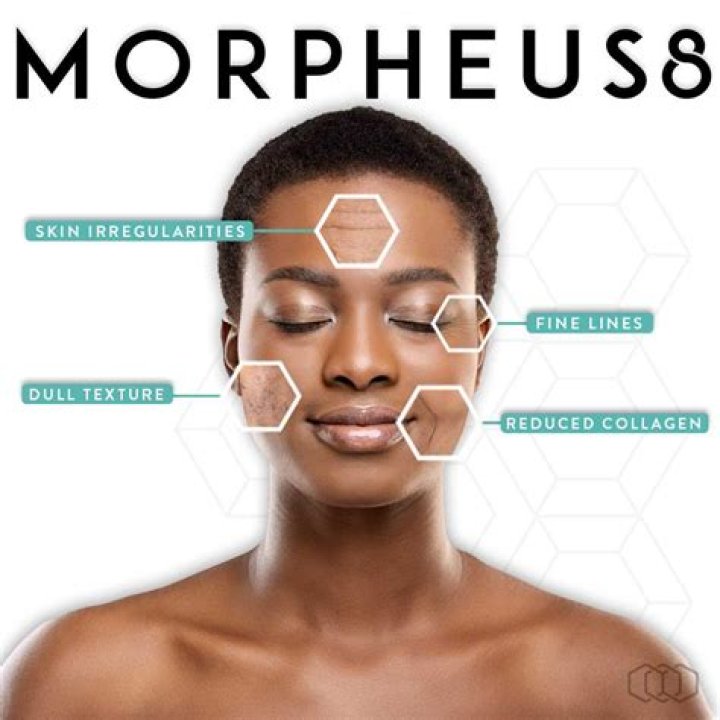 Morpheus8: The Treatment That Ruined My Skin