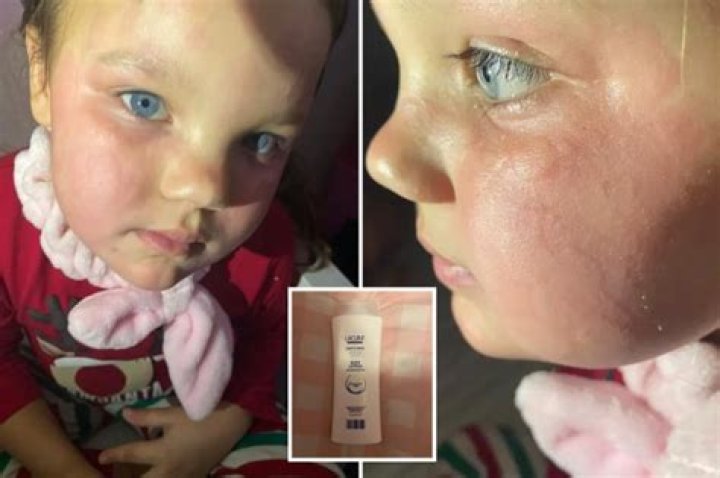 Mum horrified after Aldi lotion left her five-year-old daughter's face 'burning'