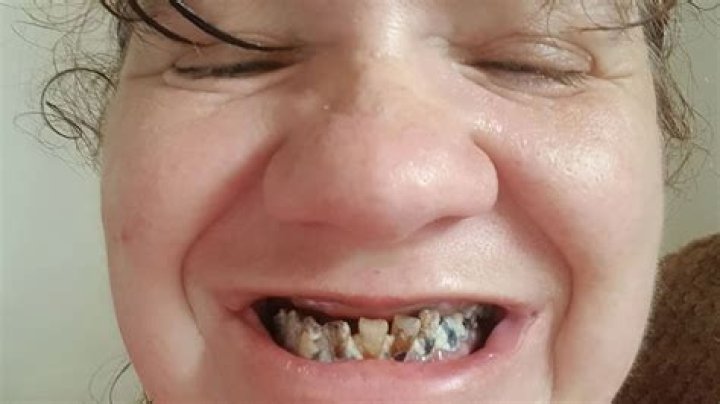 My teeth turned black and crumbled because I was too scared to go to the dentist for 10 years