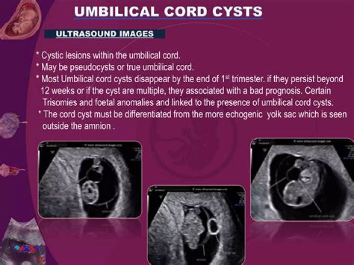 Pregnant Krystal Nielson Reveals She Has Umbilical Cord Cyst