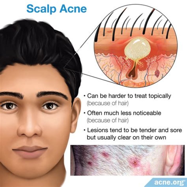 Scalp Acne: Common Causes & And How To Treat It Effectively