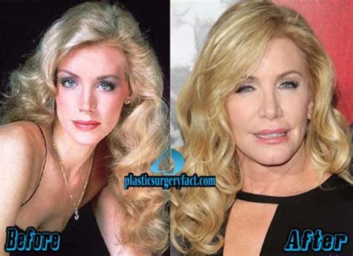 Exploring The Transformation: Shannon Tweed And Her Plastic Surgery Journey