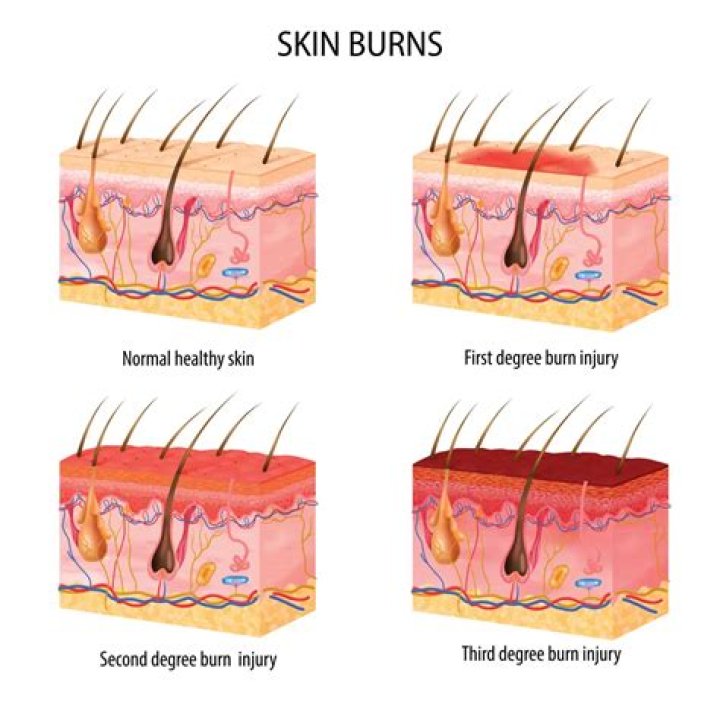 Teen, 16, suffered third degree burns after lice shampoo caught fire and engulfed her in flames
