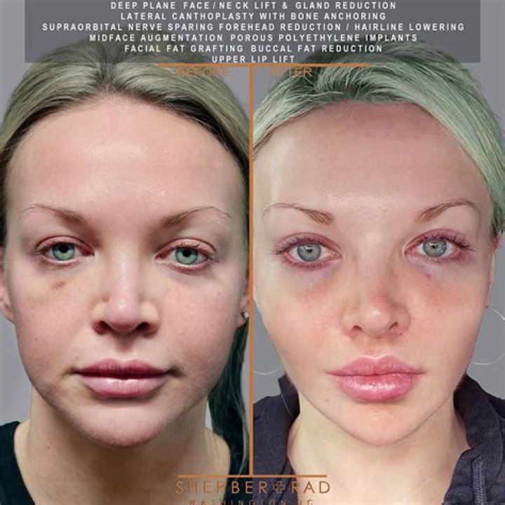 I had a thread lift and it went completely wrong - my face is botched, please don’t make the mistake I did