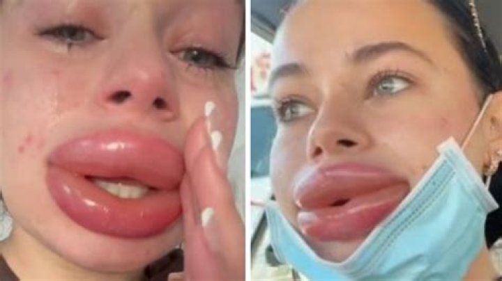 Influencer gets free lip filler, recounts horror story of botched procedure in viral video – India TV