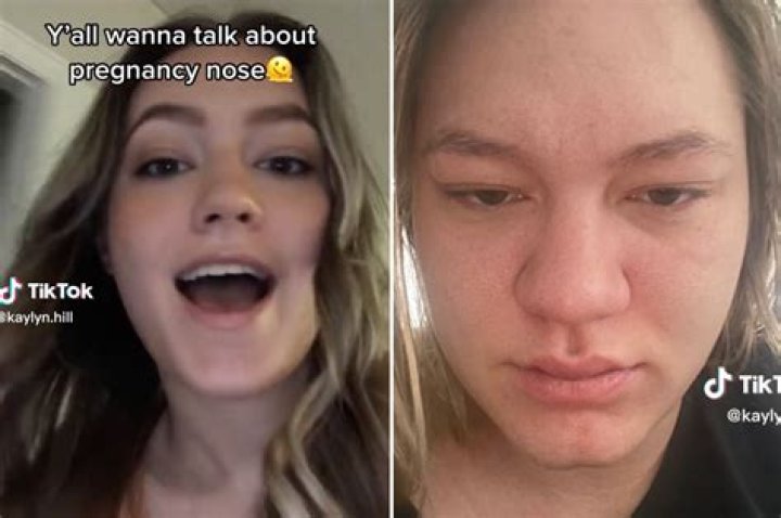 On TikTok, women are sharing their pregnancy nose. But what causes it?