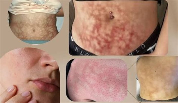 Toasted Skin Syndrome: What Is The Heat Rash, What Causes It & How Do I Treat It?