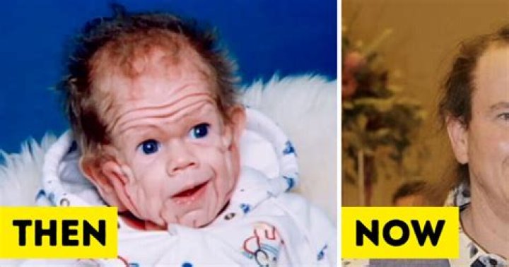 Tomm Tennent: The unique baby born with enough skin for a five-year-old child