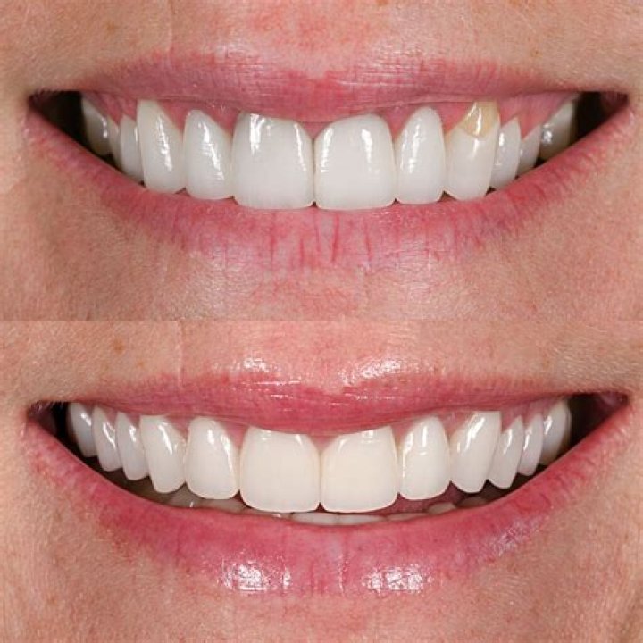 Victoria’s Secret Smile Tips From Elsa Hosk’s Dentist Dr. Apa