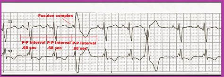 What are fusion complexes on ECG?