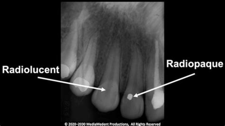 Quick Answer: What Color Is Radiolucent 2
