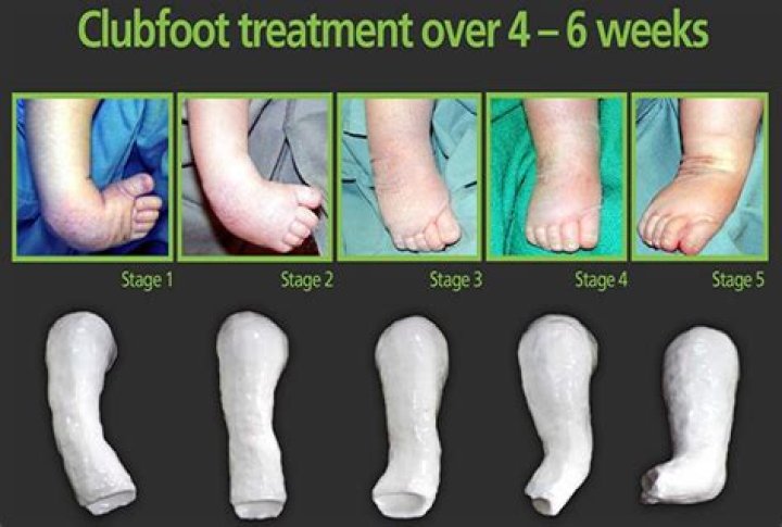 What is club foot? | The US Sun