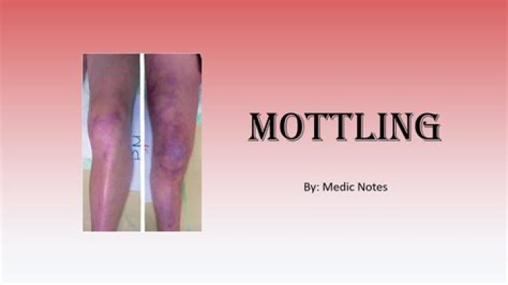 What is pigment mottling?