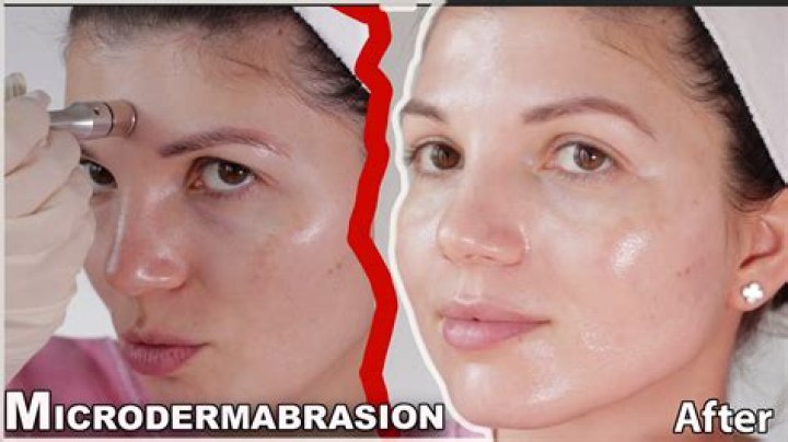 Quick Answer: What To Put On After Microdermabrasion Diy