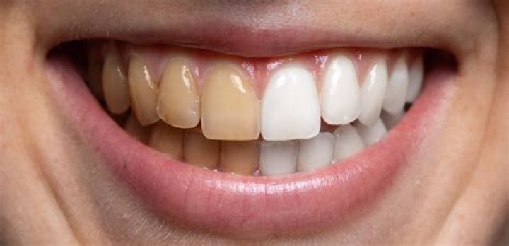 Why Do British People Have Yellow Teeth