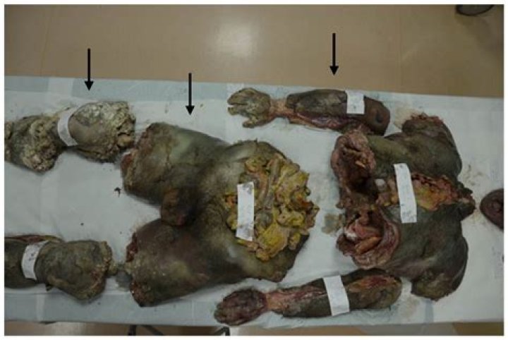 Unraveling The Tragic Tale Of A Woman Dismembered: A Story Of Loss And Grief