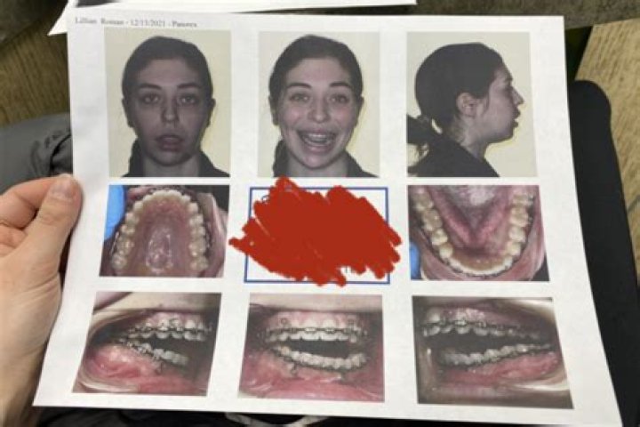Woman Explains How Her Entire Jaw Was Replaced After a Shocking Diagnosis